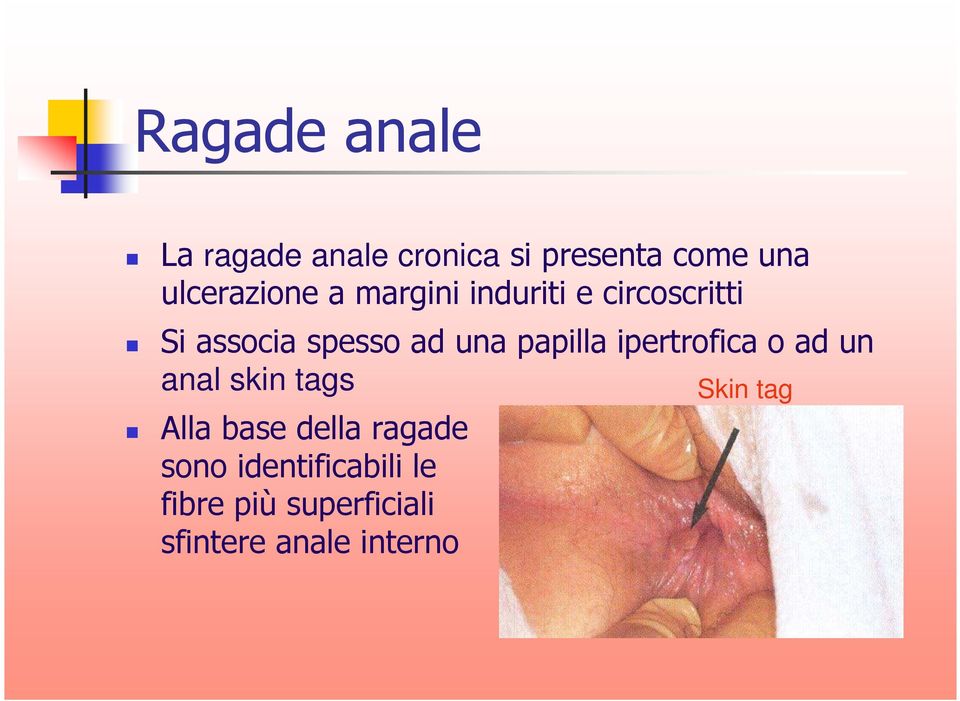 ipertrofica o ad un anal skin tags Skin tag Alla base della ragade