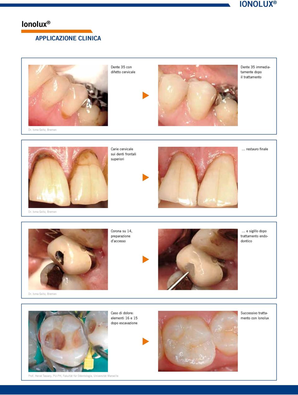 Isma Goltz, Bremen Corona su 14, preparazione d accesso e sigillo dopo trattamento endodontico Dr.