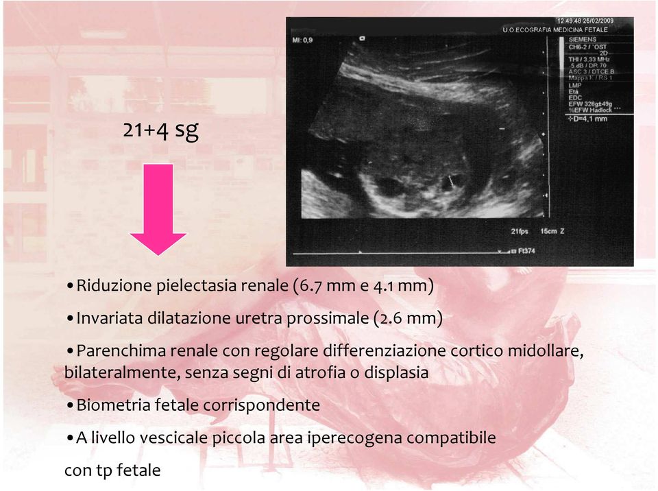 6 mm) Parenchima renale con regolare differenziazione cortico midollare,