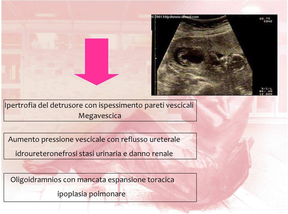 ureterale idroureteronefrosi stasi urinaria e danno renale