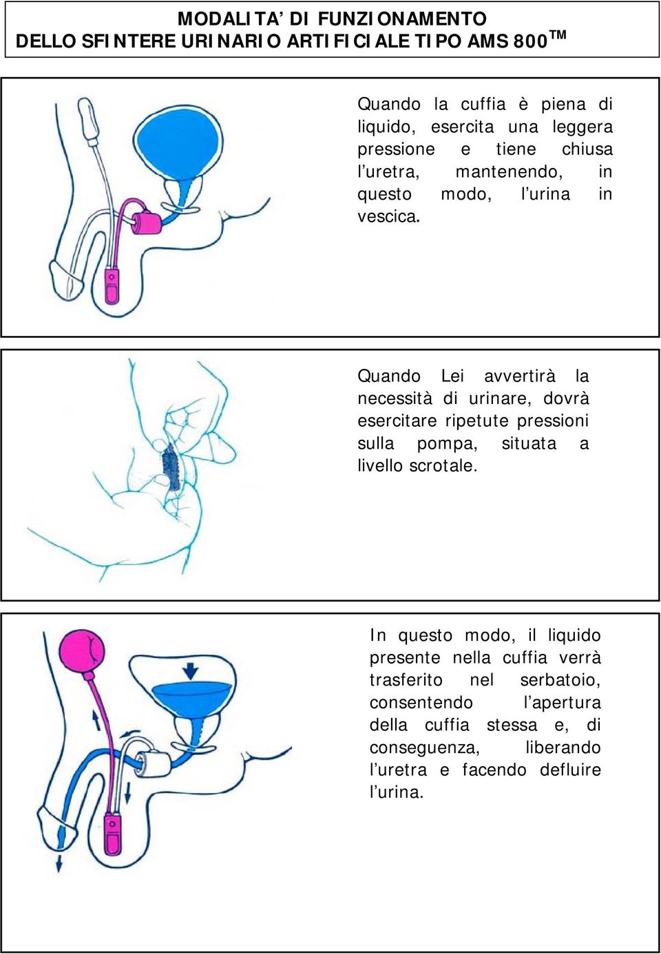 Quando Lei avvertirà la necessità di urinare, dovrà esercitare ripetute pressioni sulla pompa, situata a livello scrotale.