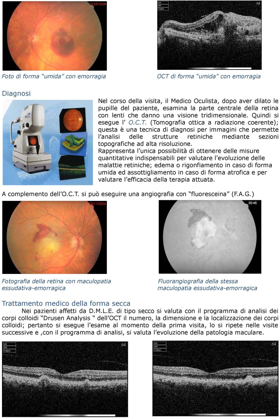 (Tomografia ottica a radiazione coerente); questa è una tecnica di diagnosi per immagini che permette l analisi delle strutture retiniche mediante sezioni topografiche ad alta risoluzione.