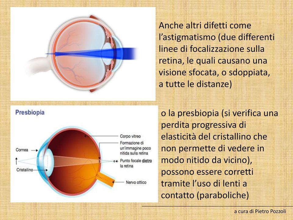 verifica una perdita progressiva di elasticità del cristallino che non permette di vedere in