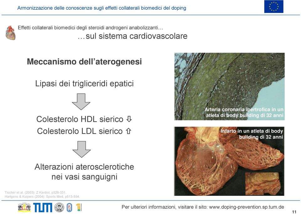 ipertrofica in un atleta di body building di 32 anni Infarto in un atleta di body building di 32 anni Alterazioni