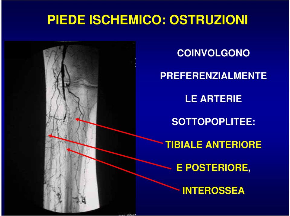 LE ARTERIE SOTTOPOPLITEE: