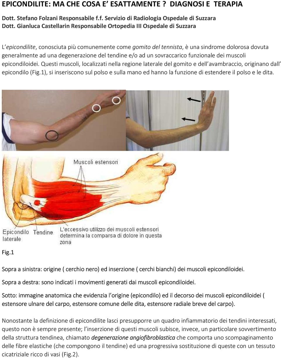 degenerazione del tendine e/o ad un sovraccarico funzionale dei muscoli epicondiloidei.