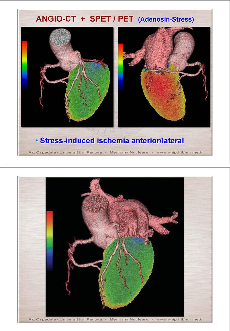 (Adenosin-Stress)