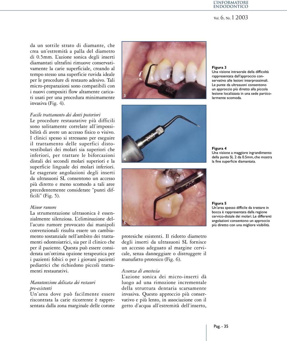 Tali micro-preparazioni sono compatibili con i nuovi compositi flow altamente caricati usati per una procedura minimamente invasiva (Fig. 4).