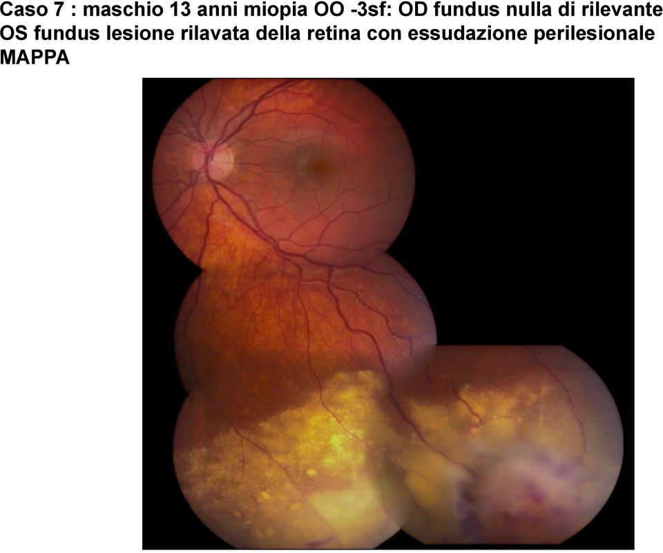 OS fundus lesione rilavata della