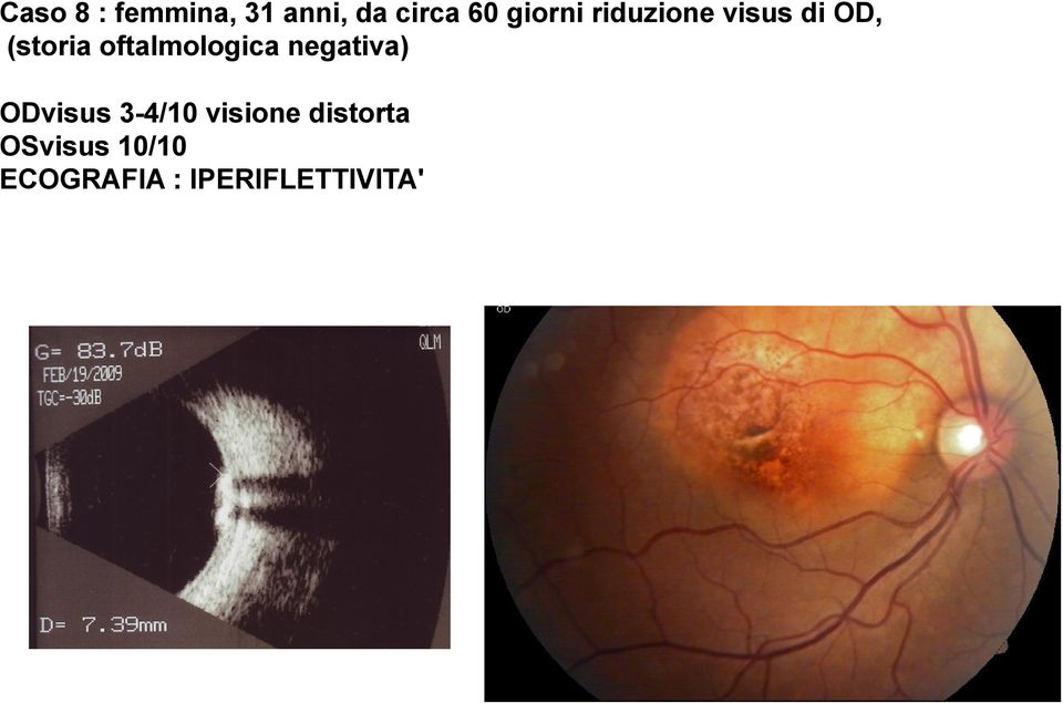 oftalmologica negativa) ODvisus 3-4/10