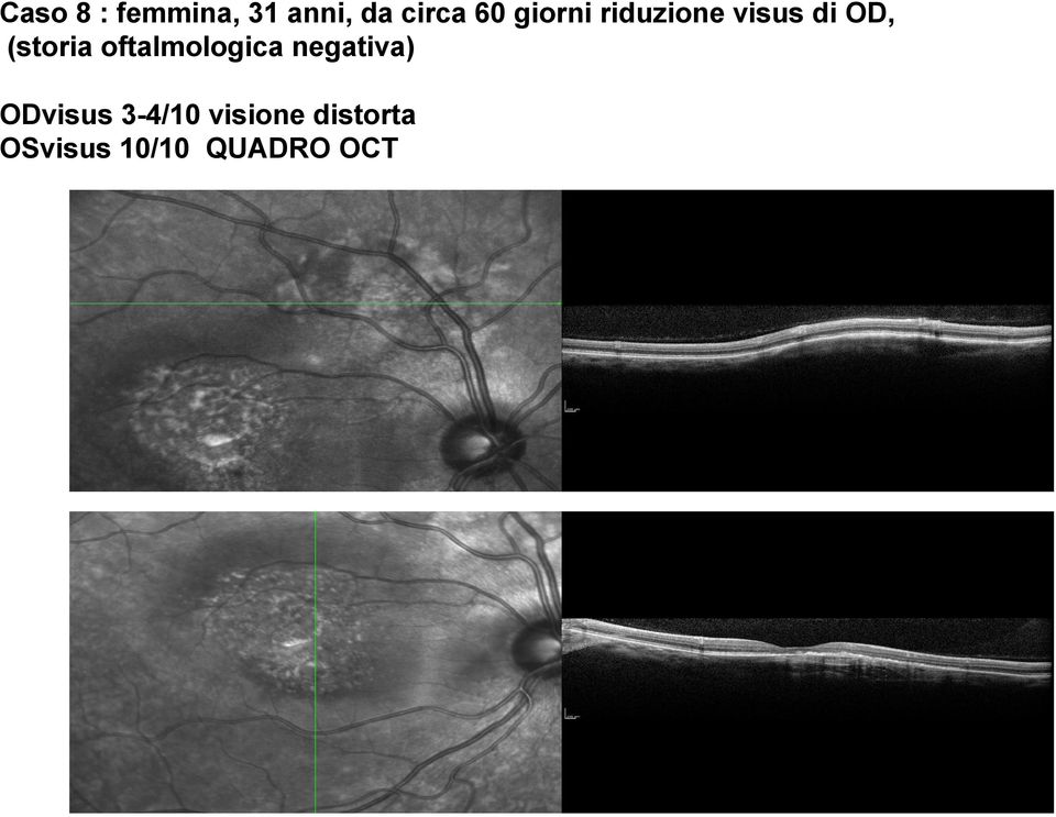 oftalmologica negativa) ODvisus 3-4/10