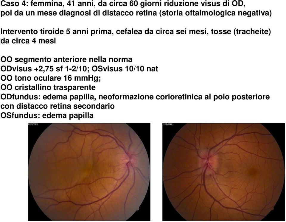 segmento anteriore nella norma ODvisus +2,75 sf 1-2/10; OSvisus 10/10 nat OO tono oculare 16 mmhg; OO cristallino