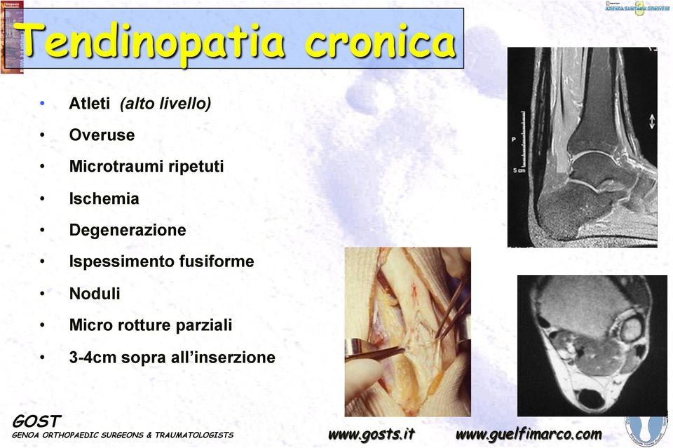 Microtraumi ripetuti Ischemia Degenerazione