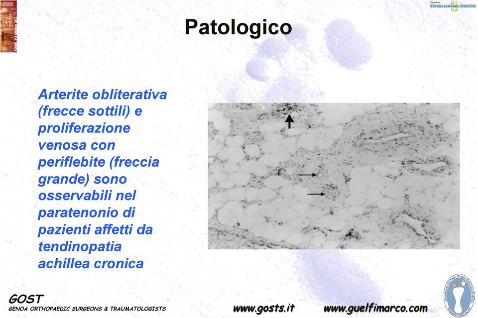 periflebite (freccia grande) sono osservabili