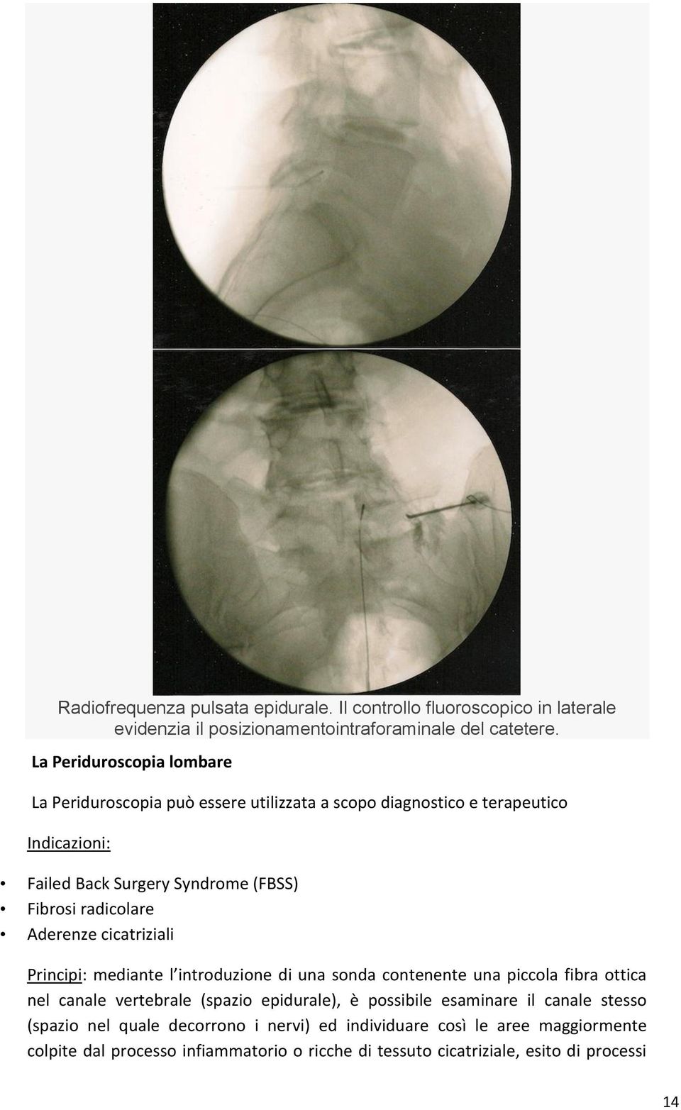 radicolare Aderenze cicatriziali Principi: mediante l introduzione di una sonda contenente una piccola fibra ottica nel canale vertebrale (spazio epidurale), è