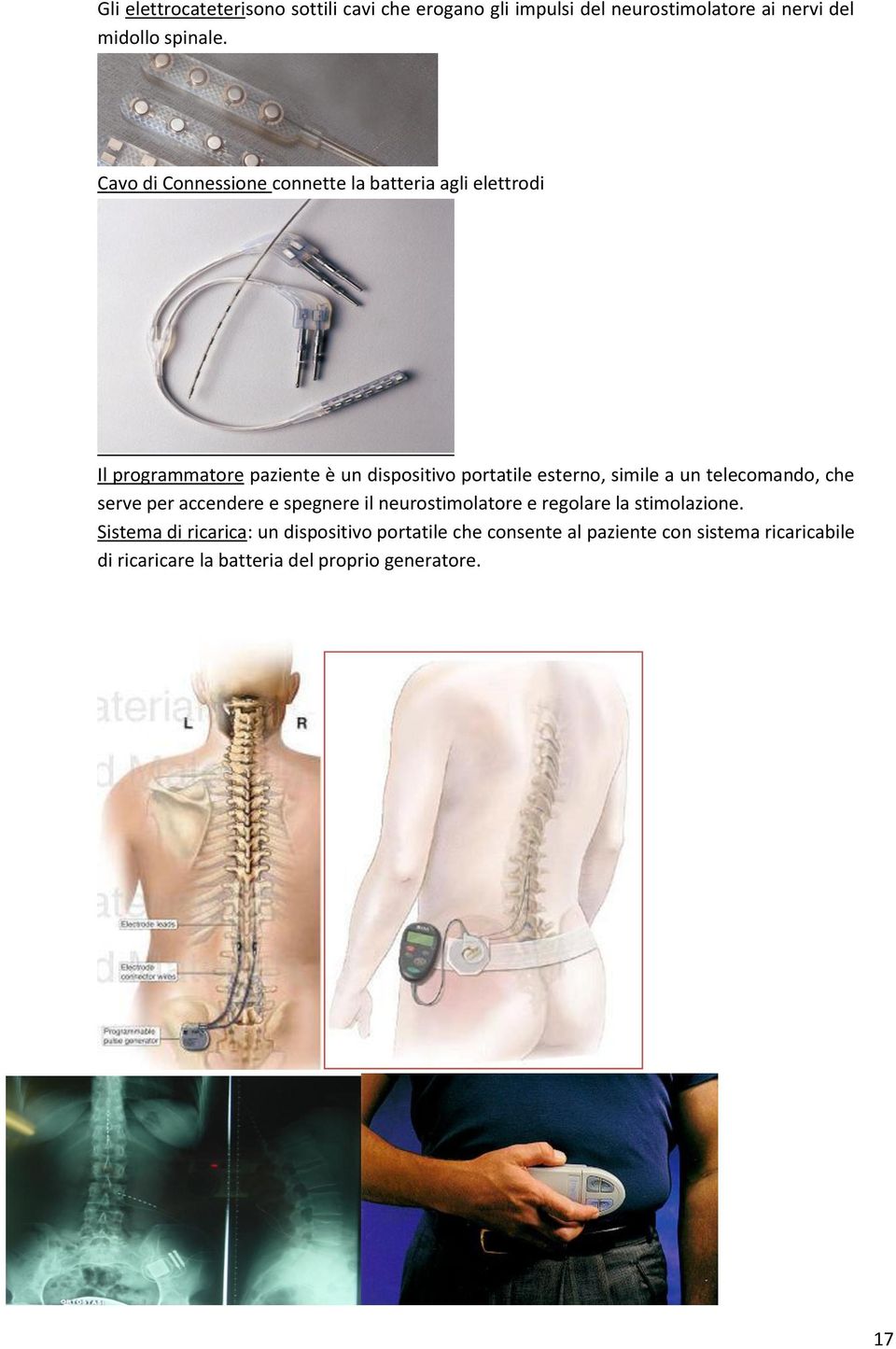 simile a un telecomando, che serve per accendere e spegnere il neurostimolatore e regolare la stimolazione.