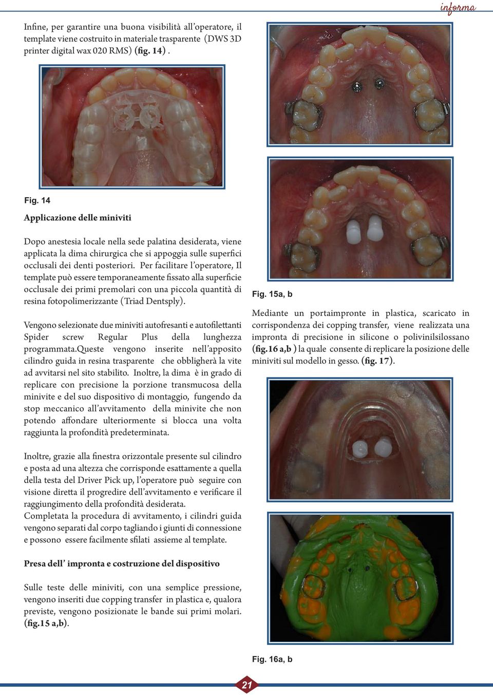 Per facilitare l operatore, Il template può essere temporaneamente fissato alla superficie occlusale dei primi premolari con una piccola quantità di resina fotopolimerizzante (Triad Dentsply).