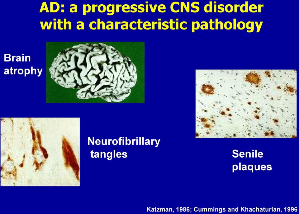 Neurofibrillary tangles Senile plaques
