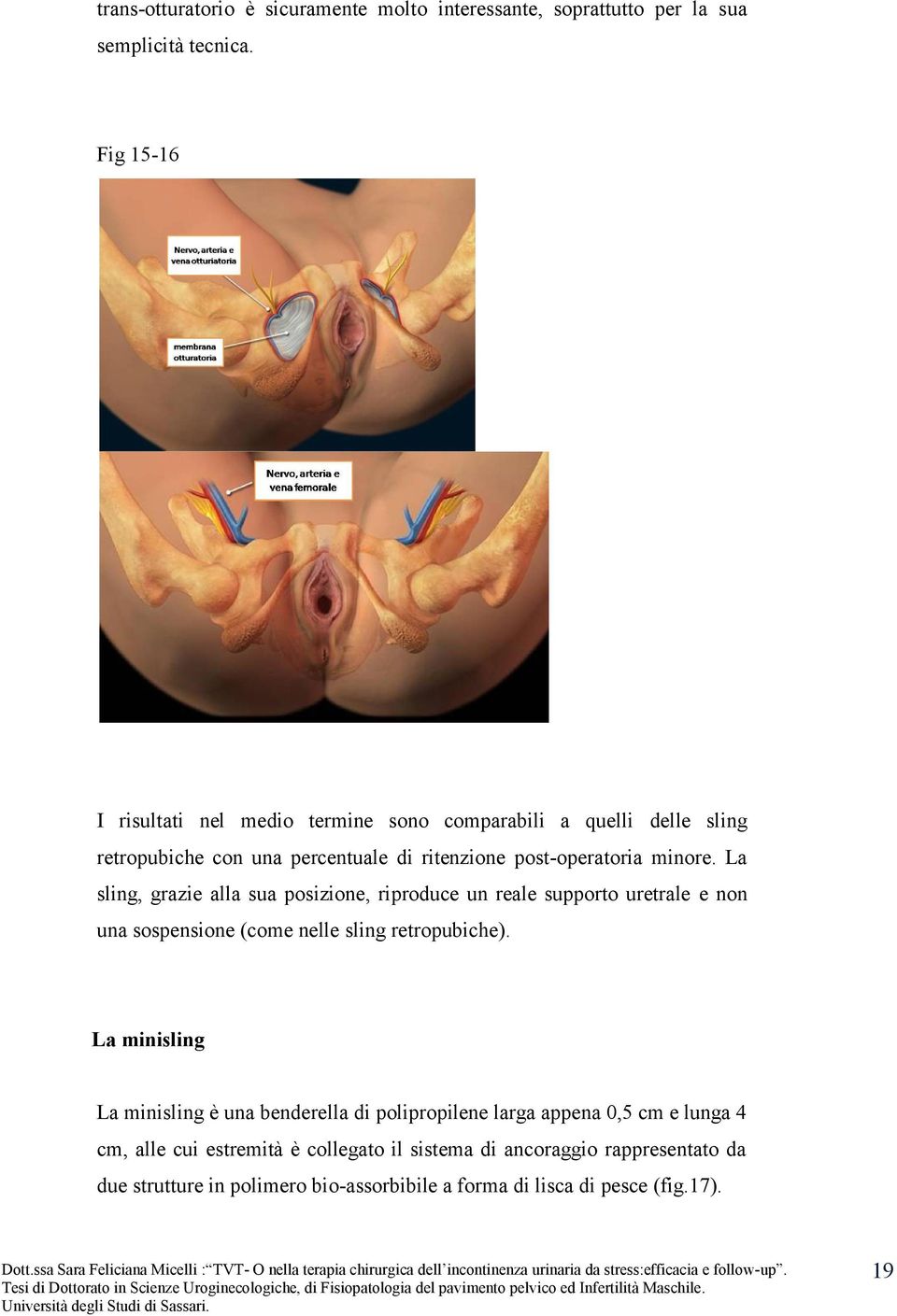 La sling, grazie alla sua posizione, riproduce un reale supporto uretrale e non una sospensione (come nelle sling retropubiche).