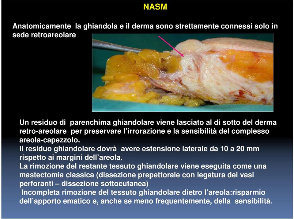 Il residuo ghiandolare dovrà avere estensione laterale da 10 a 20 mm rispetto ai margini dell areola.