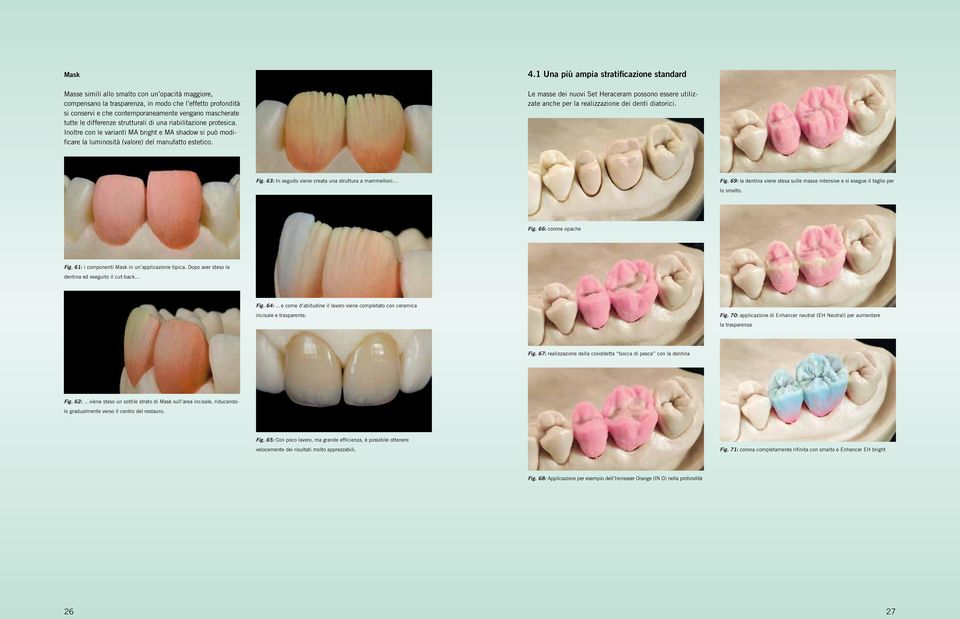 1 Una più ampia stratificazione standard Le masse dei nuovi Set Heraceram possono essere utilizzate anche per la realizzazione dei denti diatorici. Fig.