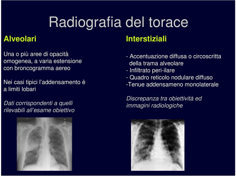 obiettivo Interstiziali - Accentuazione diffusa o circoscritta della trama alveolare - Infiltrato peri-ilare