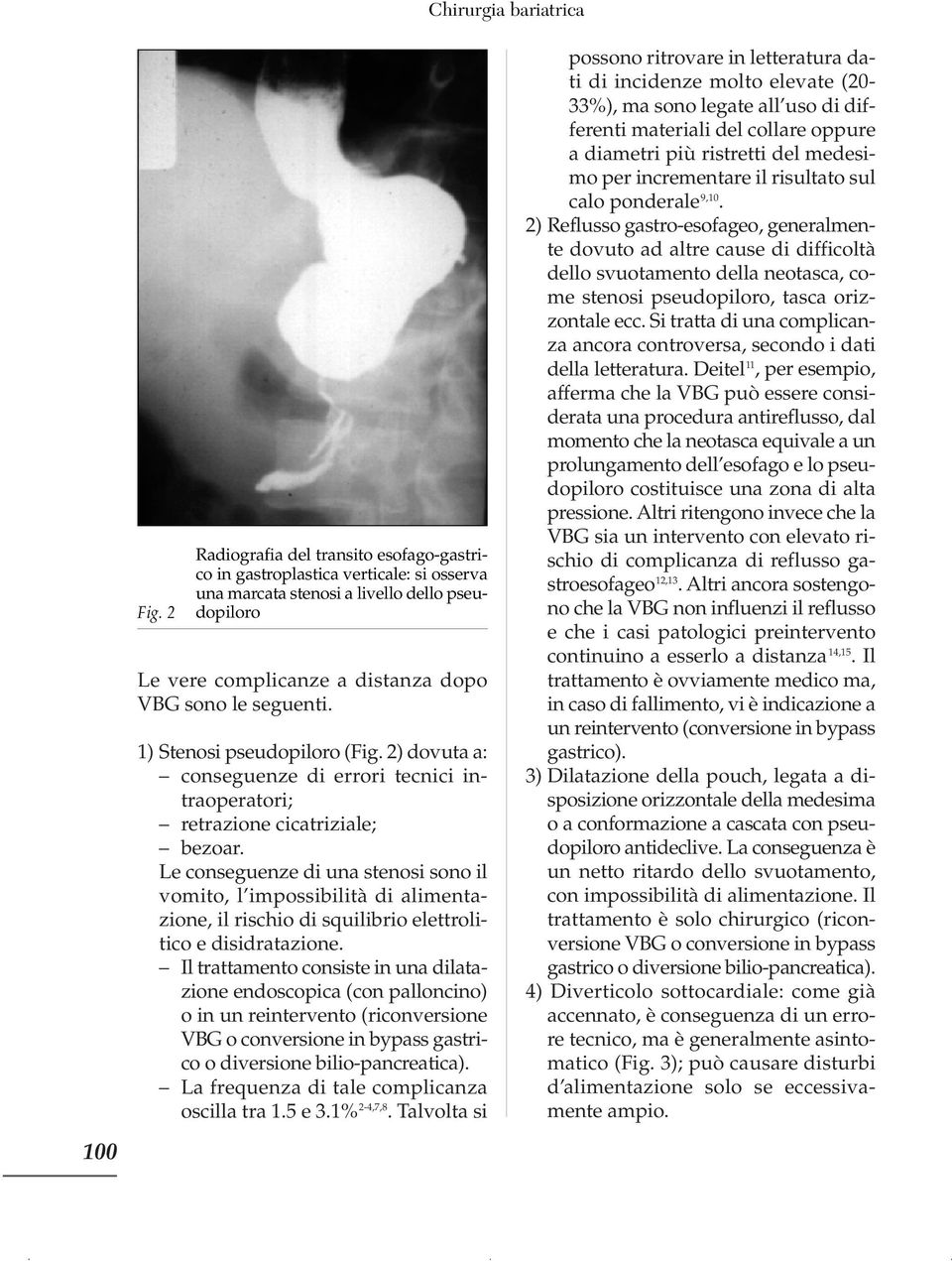 1) Stenosi pseudopiloro (Fig. 2) dovuta a: conseguenze di errori tecnici intraoperatori; retrazione cicatriziale; bezoar.