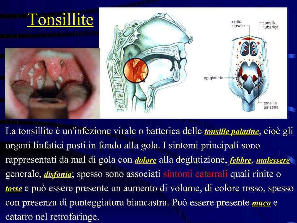 I sintomi principali sono rappresentati da mal di gola con dolore alla deglutizione, febbre, malessere generale,