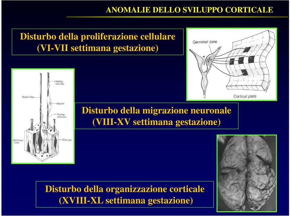 Disturbo della migrazione neuronale (VIII-XV settimana