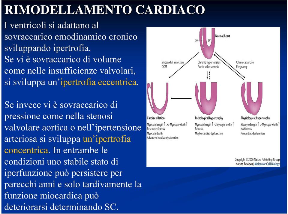 Se invece vi è sovraccarico di pressione come nella stenosi valvolare aortica o nell ipertensione arteriosa si sviluppa un