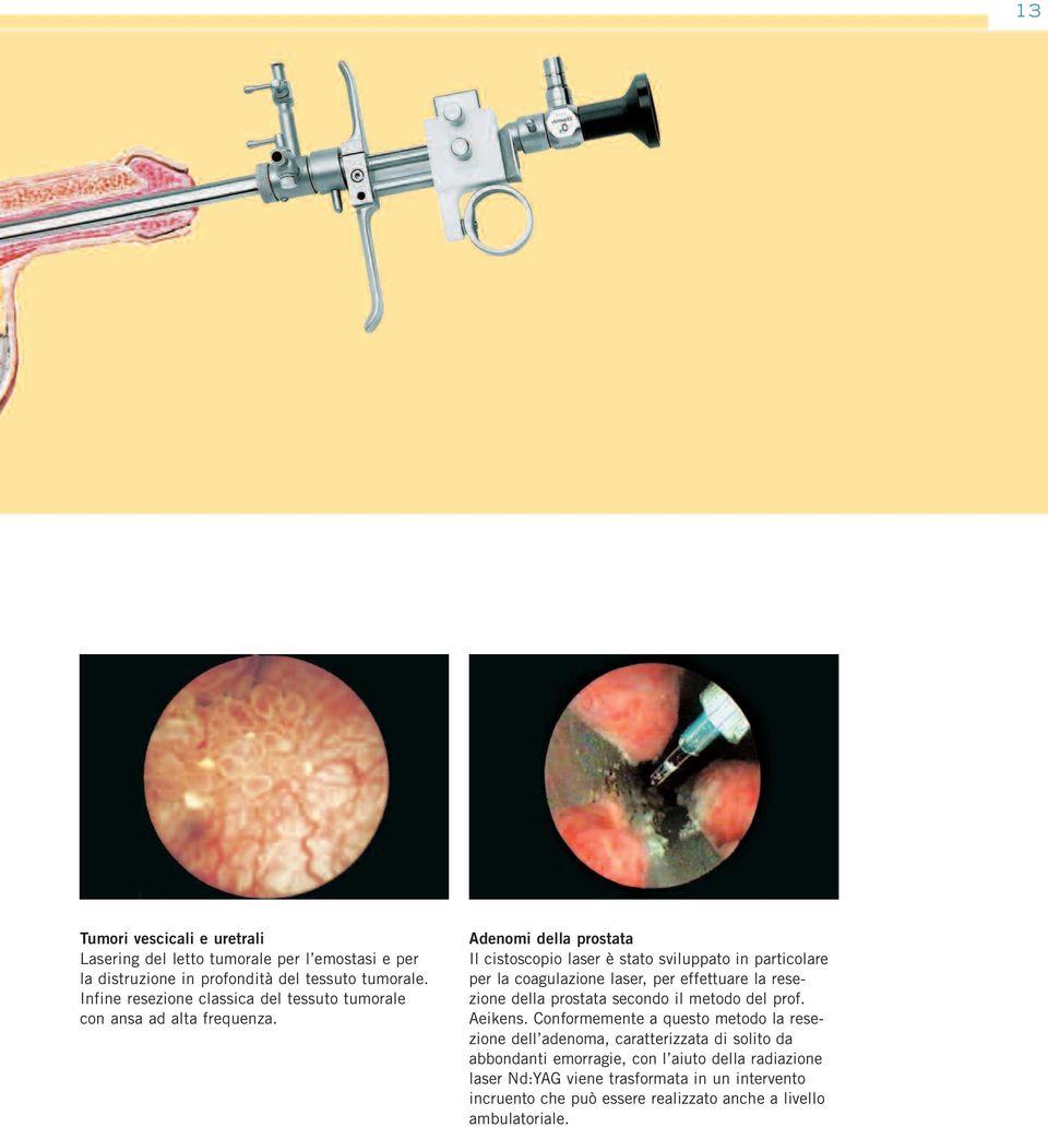 Adenomi della prostata Il cistoscopio laser è stato sviluppato in particolare per la coagulazione laser, per effettuare la resezione della prostata secondo il