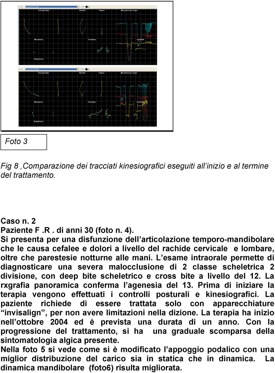 L esame intraorale permette di diagnosticare una severa malocclusione di 2 classe scheletrica 2 divisione, con deep bite scheletrico e cross bite a livello del 12.