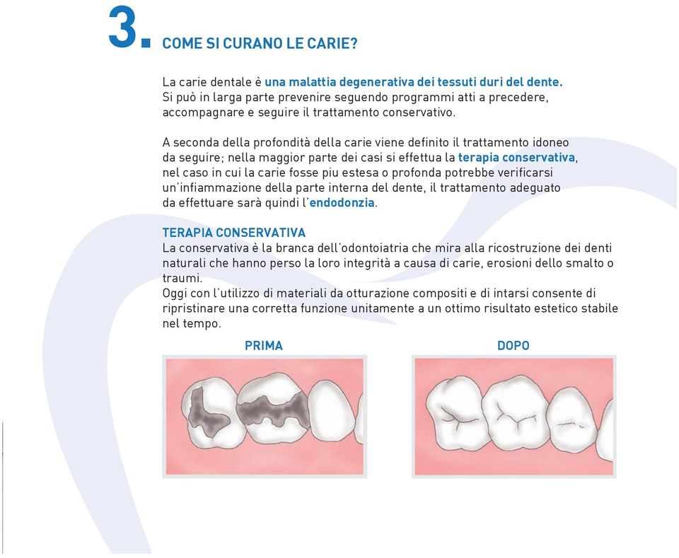 A seconda della profondità della carie viene definito il trattamento idoneo da seguire; nella maggior parte dei casi si effettua la terapia conservativa, nel caso in cui la carie fosse piu estesa o