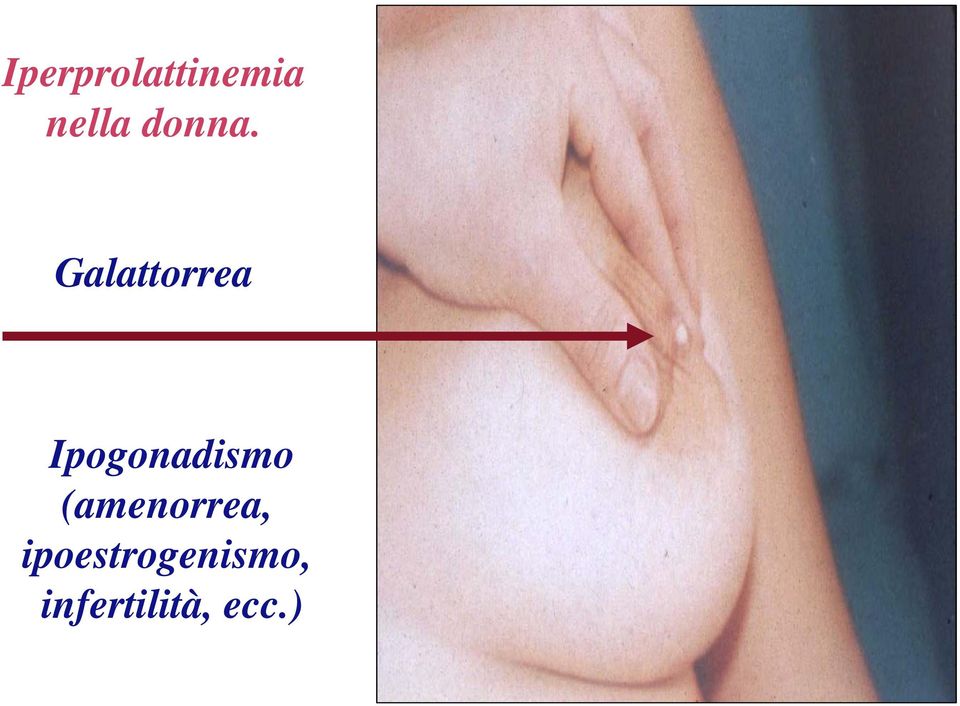 Galattorrea Ipogonadismo