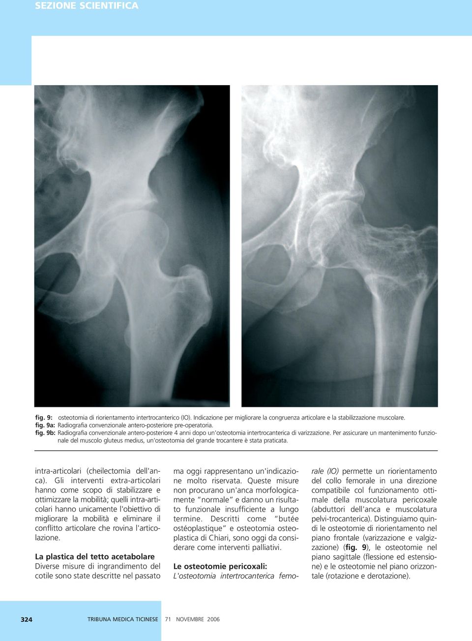 Per assicurare un mantenimento funzionale del muscolo gluteus medius, un osteotomia del grande trocantere è stata praticata. intra-articolari (cheilectomia dell'anca).