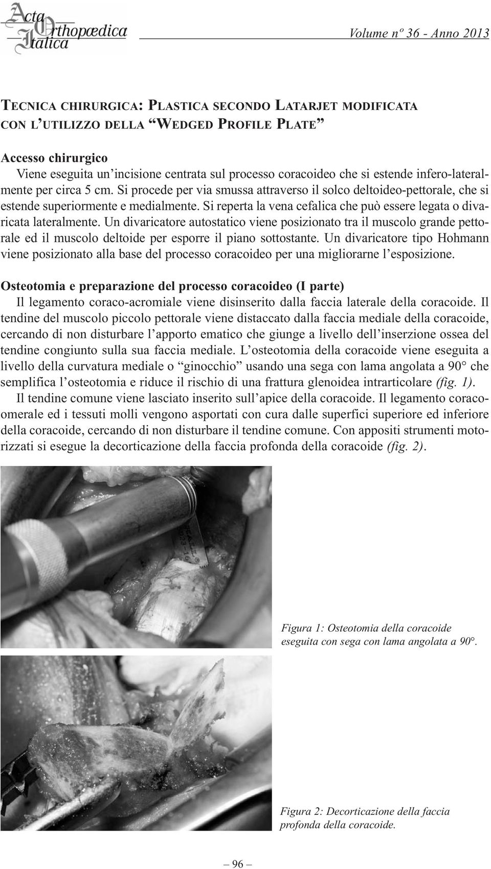 Si reperta la vena cefalica che può essere legata o divaricata lateralmente.