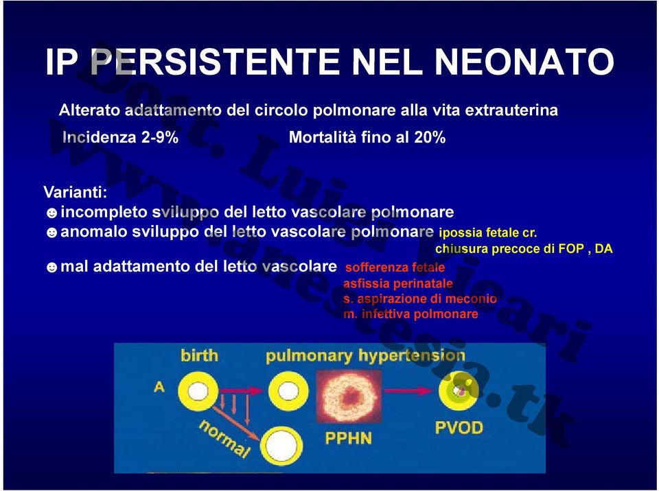 anomalo sviluppo del letto vascolare polmonare ipossia fetale cr.