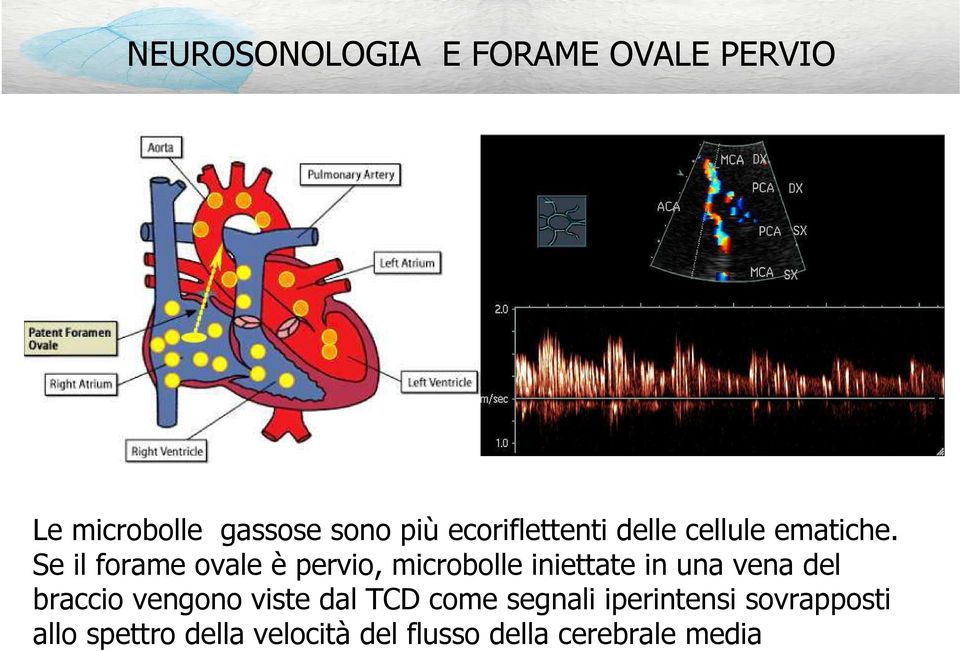 Se il forame ovale è pervio, microbolle iniettate in una vena del braccio