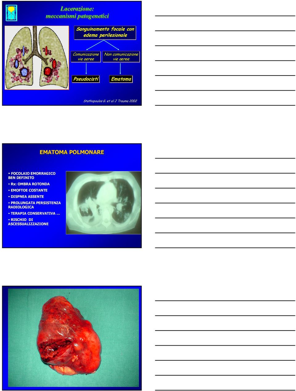 et al J Trauma 2002 EMATOMA POLMONARE FOCOLAIO EMORRAGICO BEN DEFINITO Rx: OMBRA ROTONDA