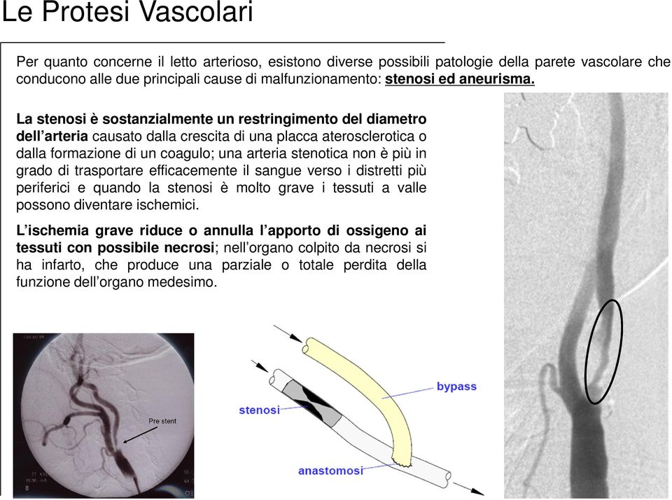 La stenosi è sostanzialmente un restringimento del diametro dell arteria causato dalla crescita di una placca aterosclerotica o dalla formazione di un coagulo; una arteria stenotica non è più