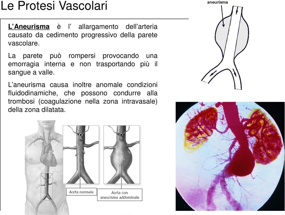 La parete può rompersi provocando una emorragia interna e non trasportando più il sangue a