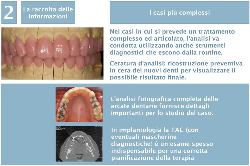 Ceratura d'analisi: ricostruzione preventiva in cera dei nuovi denti per visualizzare il possibile risultato finale.