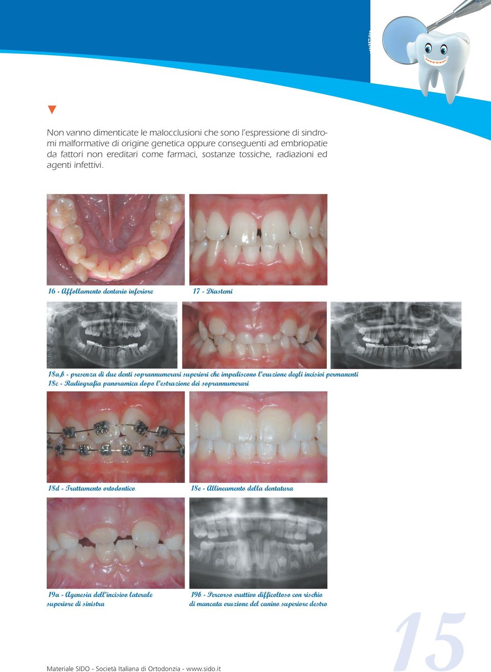 16 - Affllamnt dntari infrir 17 - Diastmi 18a,b - prsna di du dnti sprannumrari supriri ch impdiscn l ruin dgli incisivi prmannti 18c - Radigrafia panramica dp l