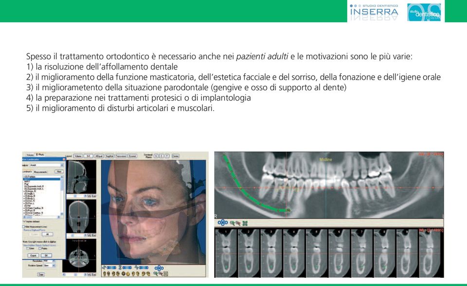 sorriso, della fonazione e dell igiene orale 3) il migliorametento della situazione parodontale (gengive e osso di