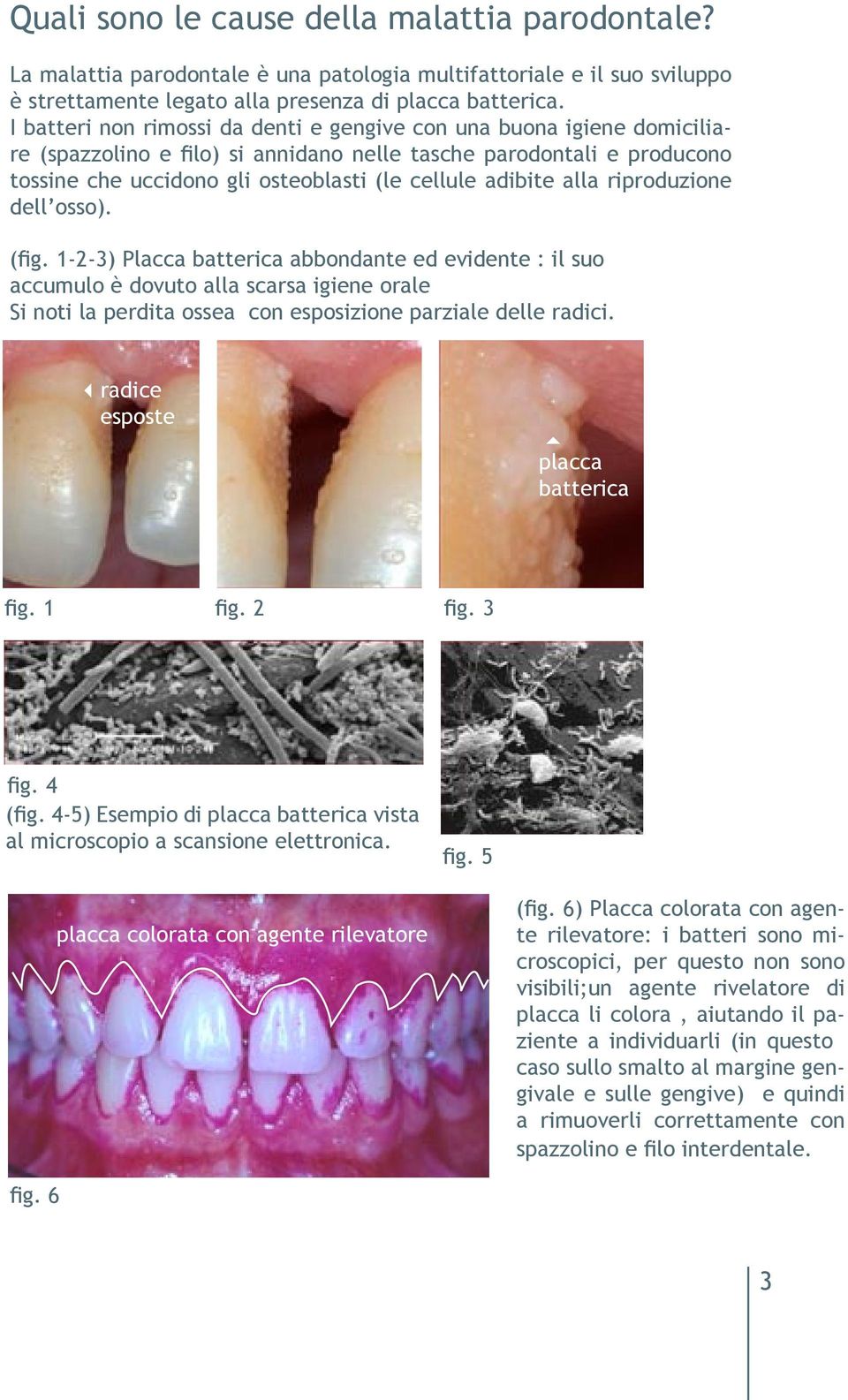 alla riproduzione dell osso). (fig. 1-2-3) Placca batterica abbondante ed evidente : il suo accumulo è dovuto alla scarsa igiene orale Si noti la perdita ossea con esposizione parziale delle radici.