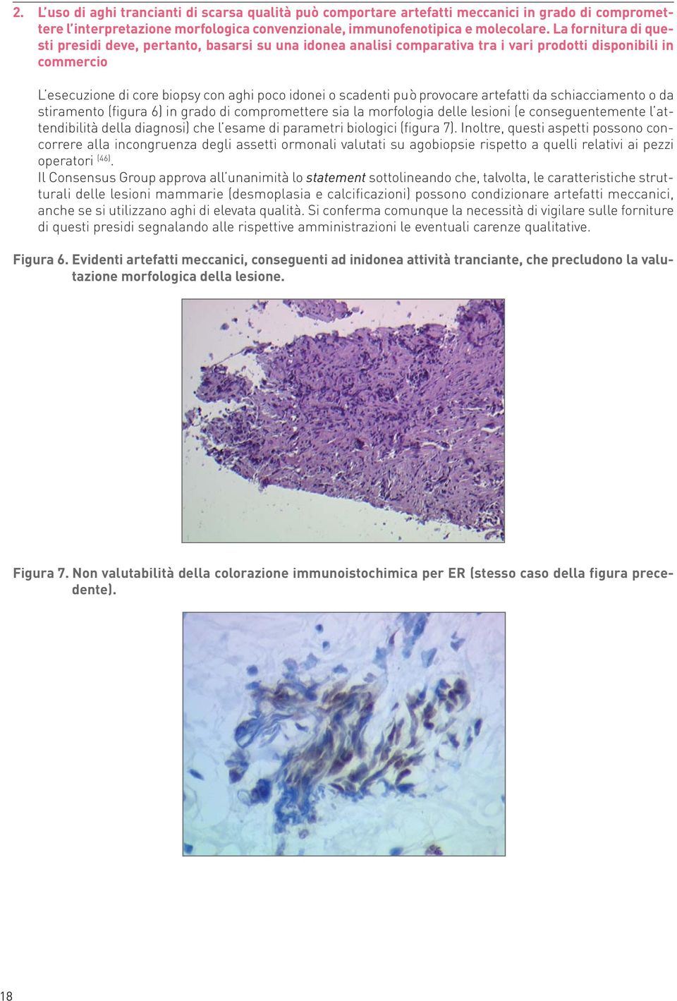 provocare artefatti da schiacciamento o da stiramento (figura 6) in grado di compromettere sia la morfologia delle lesioni (e conseguentemente l attendibilità della diagnosi) che l esame di parametri