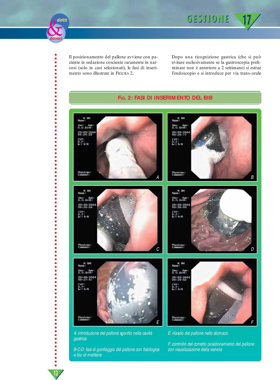 Dopo una ricognizione gastrica (che si può evitare esclusivamente se la gastroscopia preliminare non è anteriore a 2 settimane) si estrae l endoscopio e si introduce