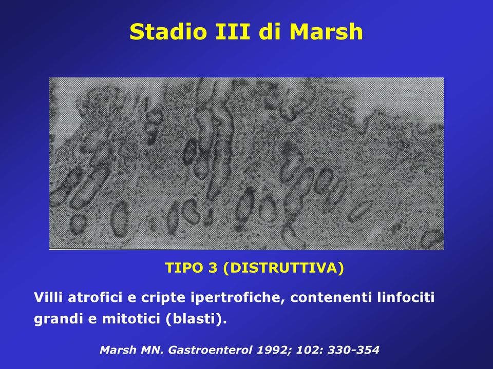 contenenti linfociti grandi e mitotici