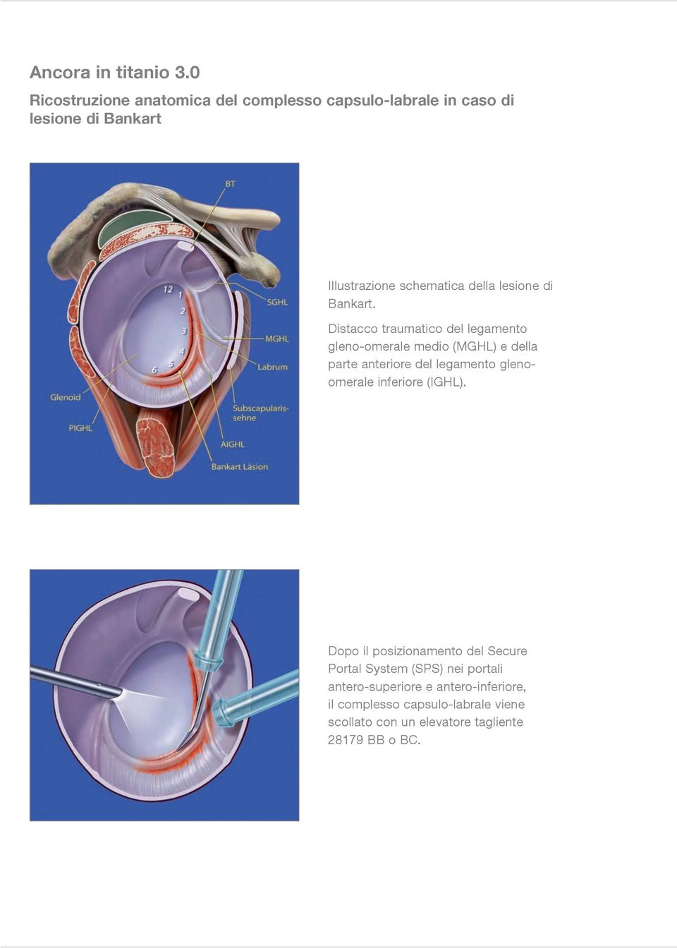 lesione di Bankart.