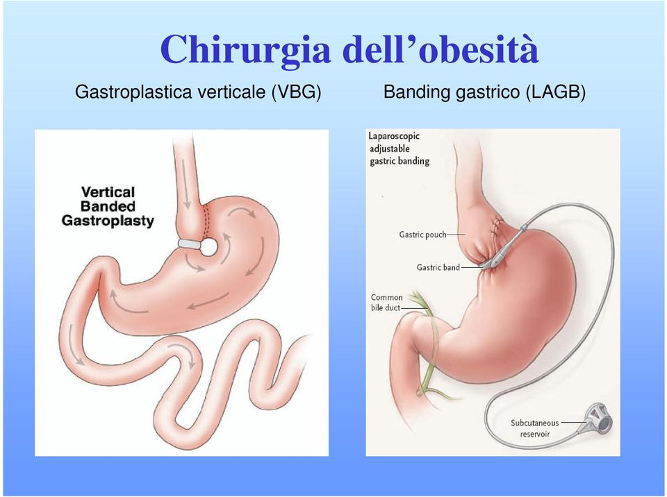 Gastroplastica